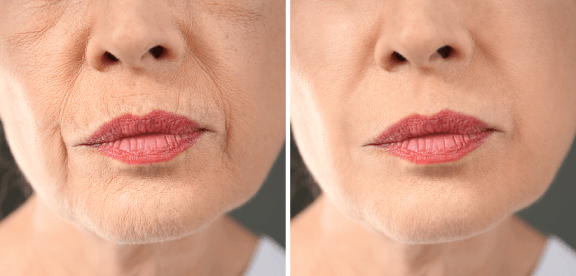 RF Microneedling | Elanté Rejuvenation | Medical Grade Aesthetics Clinic | SW Calgary