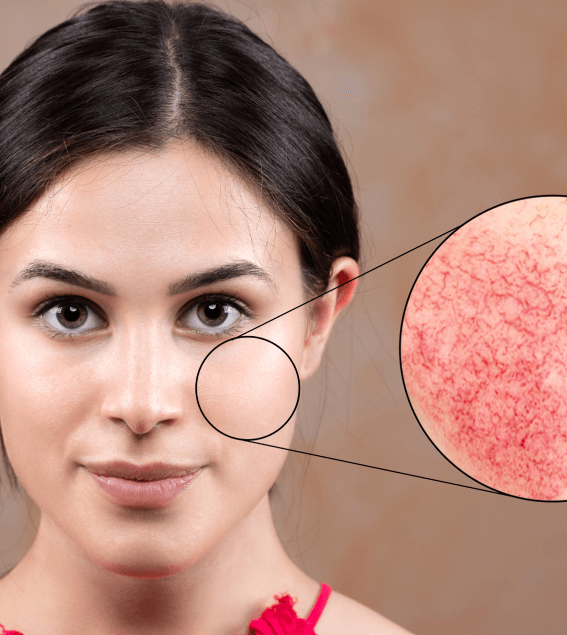 Laser for Vascular Lesions | Elanté Rejuvenation | Medical Grade Aesthetics Clinic | SW Calgary