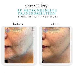 RF Microneedling | Before & After | Elanté Rejuvenation | Medical Grade Aesthetics Clinic | SW Calgary