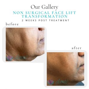 Non Surgical Face Lift | Before & After | Elanté Rejuvenation | Medical Grade Aesthetics Clinic | SW Calgary