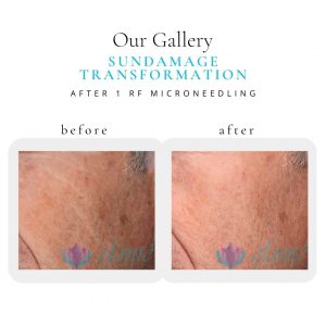 Sun Damage | Before & After | Elanté Rejuvenation | Medical Grade Aesthetics Clinic | SW Calgary