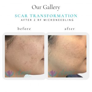 Scar | Before & After | Elanté Rejuvenation | Medical Grade Aesthetics Clinic | SW Calgary