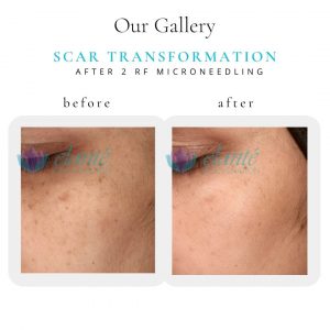 Scar | Before & After | Elanté Rejuvenation | Medical Grade Aesthetics Clinic | SW Calgary