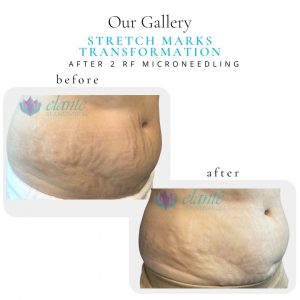 Stretch Marks | Before & After | Elanté Rejuvenation | Medical Grade Aesthetics Clinic | SW Calgary